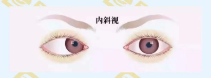 什么是調(diào)節(jié)性內(nèi)斜視？