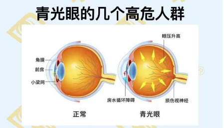 青光眼的幾個(gè)高危人群？