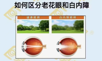 如何區(qū)分老花眼和白內(nèi)障？