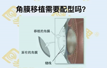 角膜移植需要配型嗎？
